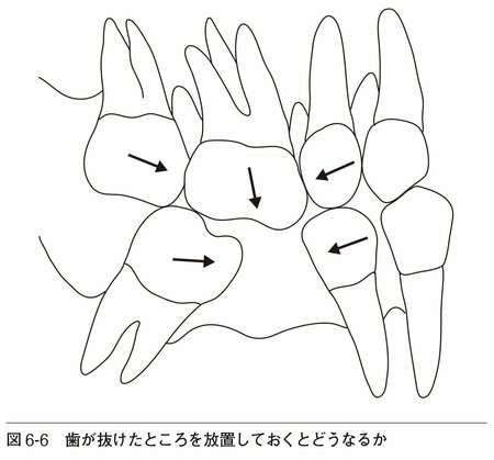 図6-6:歯が抜けたところを放置しておくとどうなるか