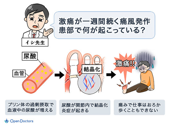 痛風のメカニズム