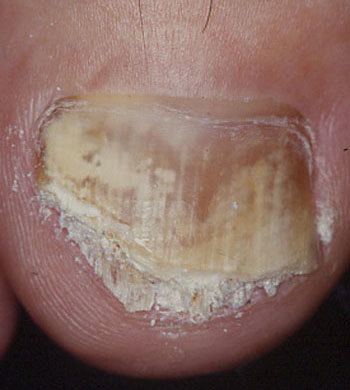白癬 菌 爪
