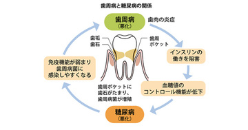 糖尿病とメタボの予備軍は要注意！口腔ケアが全身の健康につながる