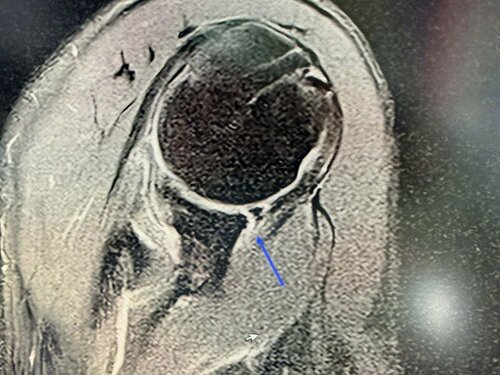 腱板断裂に関節唇損傷。またやってしまいました……。