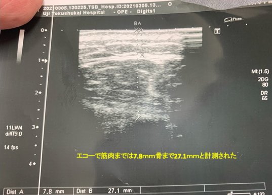 エコーで皮下組織の厚さを確認する