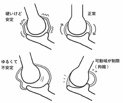 拘縮