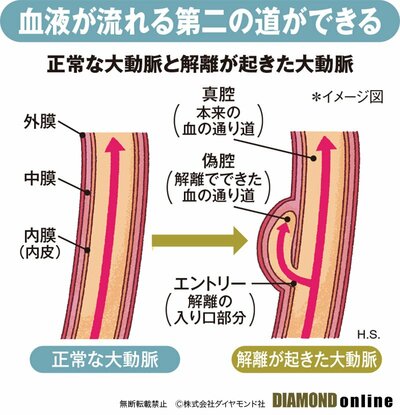 図表：正常な大動脈と解離が起きた大動脈