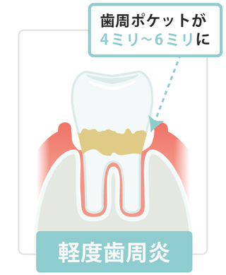 軽度歯周病