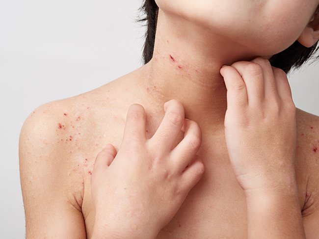 皮膚科専門医から、アトピーの子をもつ親へ。どうか「かいちゃダメ!」って言わないで。