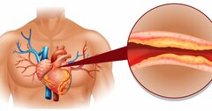 悪玉コレステロールが160を超えると、心臓病リスクが2.6倍上がる！