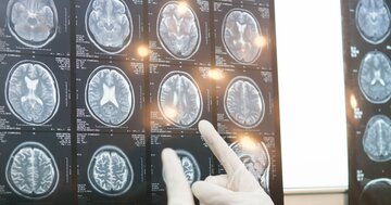 糖尿病で「脳が老化」するリスク…認知症の早期警告サインか【3万人の脳MRIデータで判明】