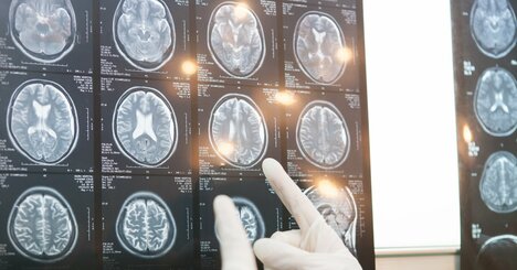 糖尿病で「脳が老化」するリスク…認知症の早期警告サインか【3万人の脳MRIデータで判明】
