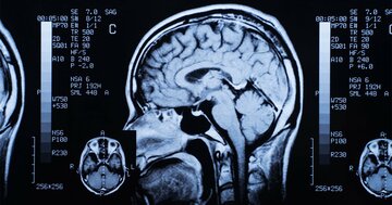 ステロイド薬の長期間使用で「脳の構造が変化」の可能性、研究結果の詳細は？