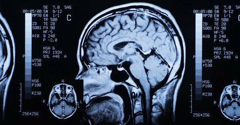 ステロイド薬の長期間使用で「脳の構造が変化」の可能性、研究結果の詳細は？