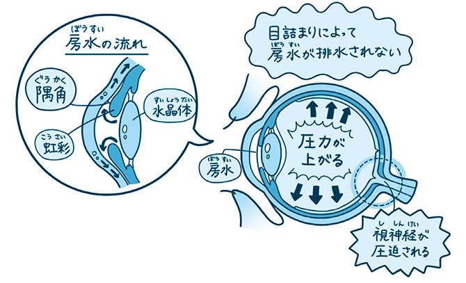 【ハーバード × スタンフォードの眼科医が指南】<br />痛くもかゆくもないのに失明寸前!?<br />「頭痛と吐き気がひどい目の病気とは?」