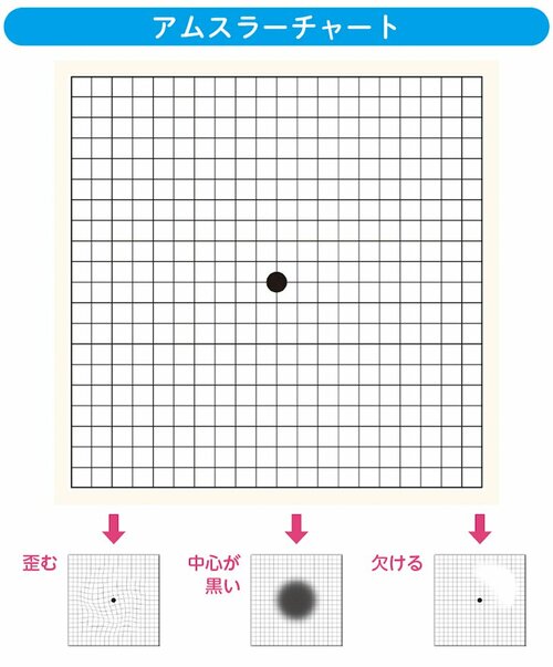 アムスラーチャート