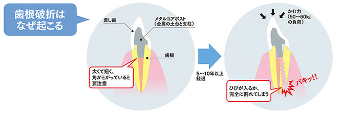 知らぬ間に歯が割れる 歯根破折の治療法と費用 主な原因 口腔外科book