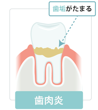 歯肉炎