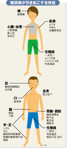 患者・予備群1600万人の「糖尿病」―ますます急増する現代病