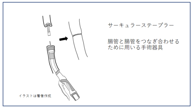 【外科医が教える】手術で腸を縫うとき、昔は糸と針で手作業していた。では、いまは？