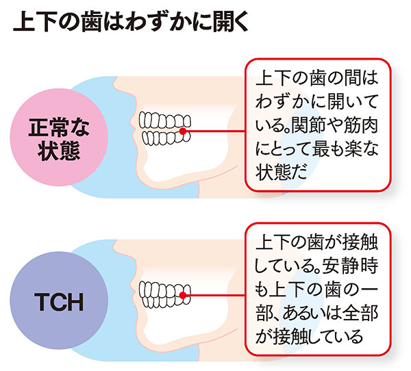 上下の歯の接触が原因となる<br />あごの痛み（顎関節症）