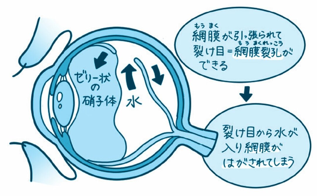 【ハーバード×スタンフォードの名医が教える】<br />多くの人が抱える「飛蚊症」に隠された驚きの原因とは?