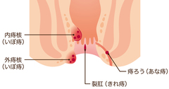 「痔主」3人に1人なのに半数が治療しない日本おしり事情