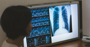 50歳未満での「がん発症」が世界中で増加、体内の意外な要素が関与の可能性