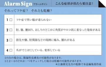 フケ症に悩んでいませんか?乾癬の最新治療