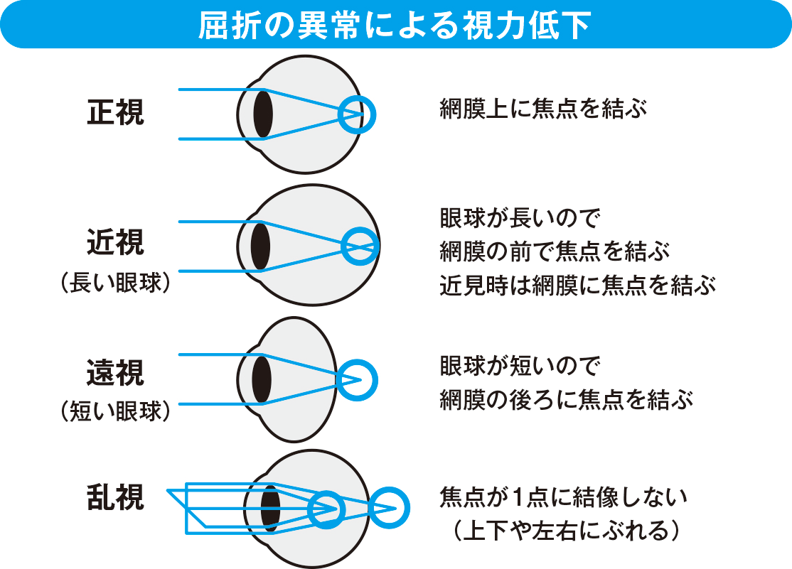 屈折の異常による視力低下 屈折の異常による視力低下