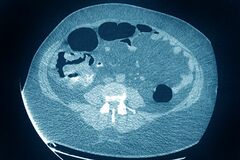 米の大腸がん患者、55歳未満の割合倍増　原因不明